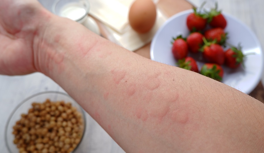 Türkiye’nin alerji haritası çıkarıldı